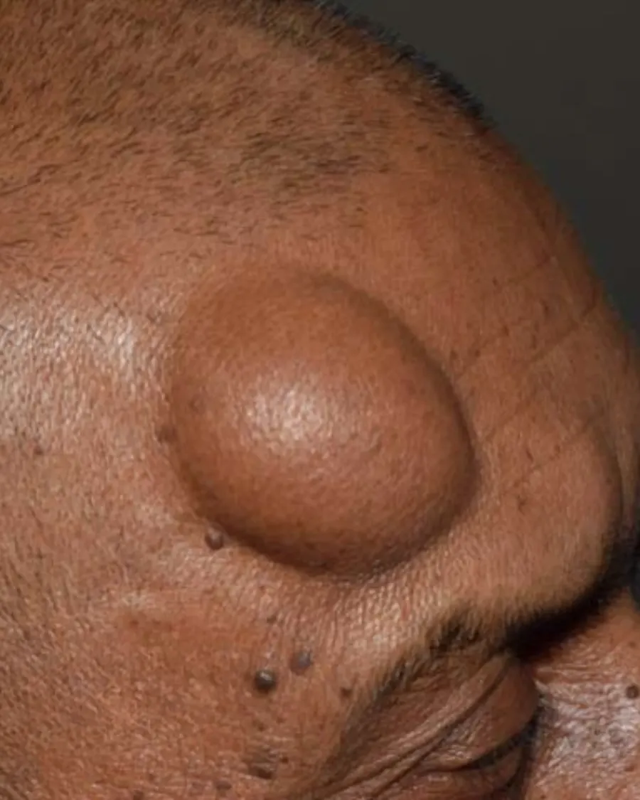 Lipoma excision at Cinch Clinics